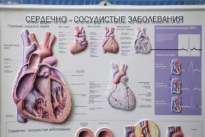 Слишком большое сердце. Что такое кардиомиопатия?
